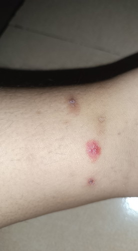 Hi mGa ma'am and Tanung Kong lang Anung insekto Po kaya ung Ganyang klaseng pantal Minsan nag Tubig