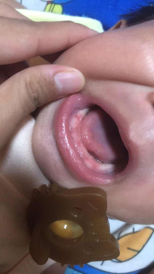 แบบนี้ฟันน้องกำลังขึ้นใช่มั้ยค่ะ