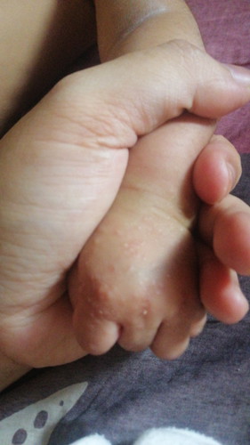 ada ke baby mommy Yg kena mcm ni? doc kata bukan hfmd..