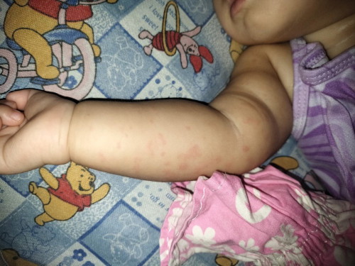 Mga mashies ano po kaya pwede igamot nagkaron kase ng pula pula baby ko 10months old sya ..
