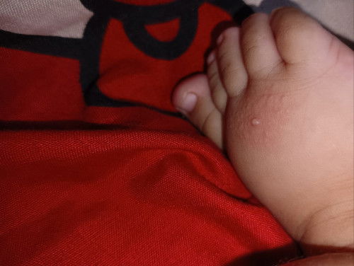 Bintik" merah pada bayi 3 bulan