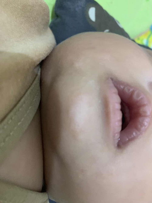 Merah merah di bawah bibir