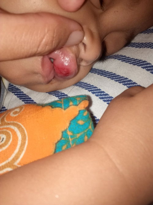Anak umur 15+ bulan habis jatuh, bibirnya kenak lantai(bibir jontor)
