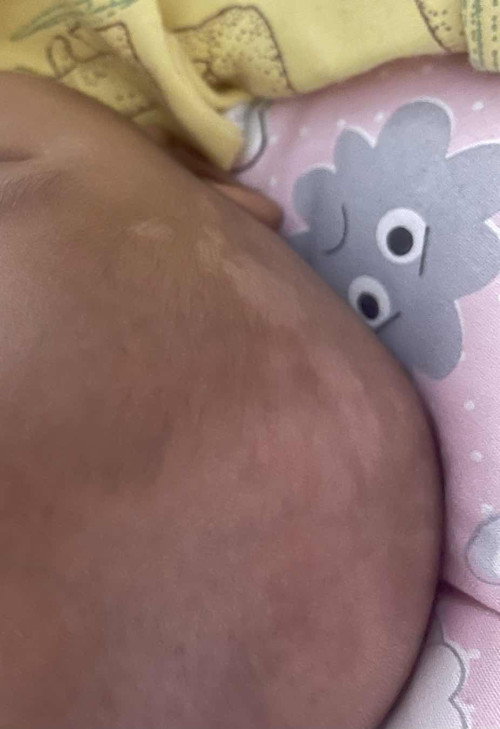 BERCAK PUTIH
