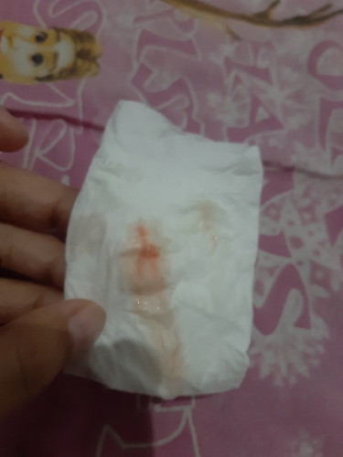Bunda aku hamil pertama dan baru 8 minggu tapi keluar ginian kenapa ya?
Takut banget