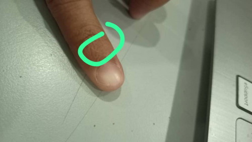 Masalah kulit dekat kuku