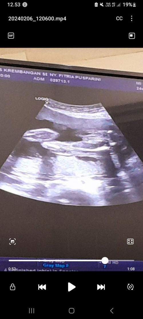 Apa bener ini usg jenis kelamin cowok