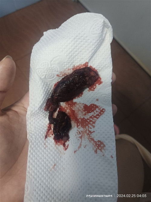 แท้ง (ท้องแรก)