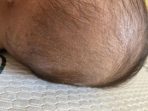 Kulit kepala bayi kering