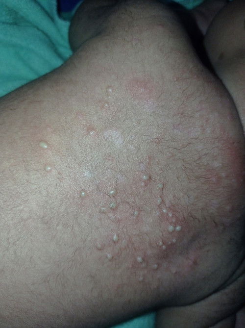 Punggung bayi bruntusan parah