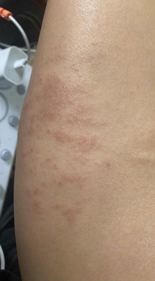 ผื่นคันขึ้นขา ตั้งครรภ์อ่อนๆ