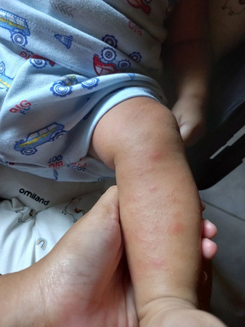 Bruntusan dan merah tangan dan kaki bayi 4 bulan