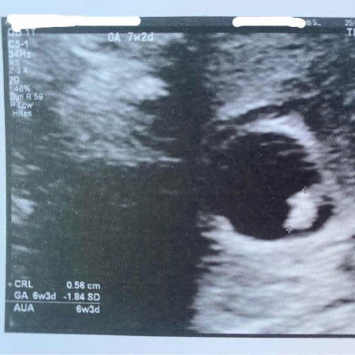 คุณแม่บ้านอื่นเจอเจ้าก้อนตอนกี่วีคกันคะ ขนาดเท่าไหร่บ้างคะ