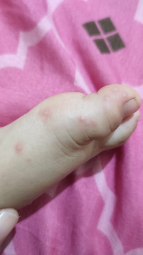 Ada yang pernah beruntus di daerah kaki , dan badan kayak gini gak mom usia 11 bulan ditambah panas