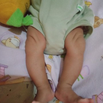 Kaki bayi seperti letter O