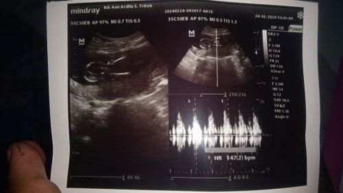 Mau tanya kalo USG kaya gini itu cewe atau cowo ya