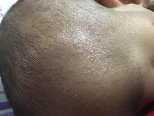 bayi 7 bulan bintik di kepala seperti biang keringat