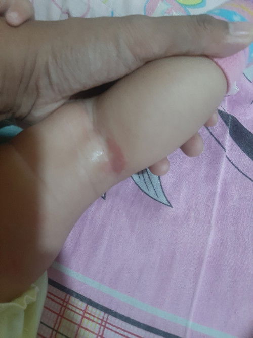 Rashes or dermatitis?