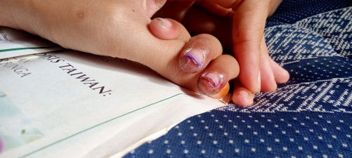 Ujung jari kuku luka mengelupas