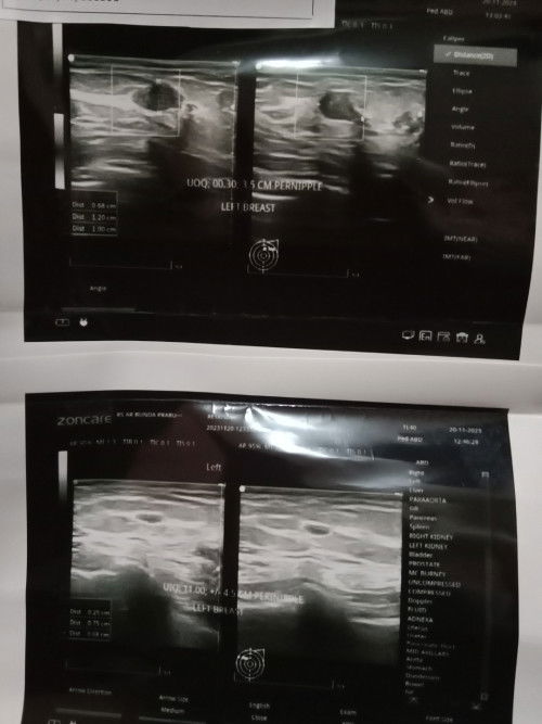 Benjolan di payudara kiri saat hamil