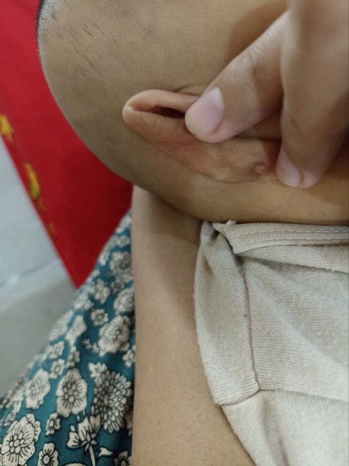 Luka pada telinga akibat anting