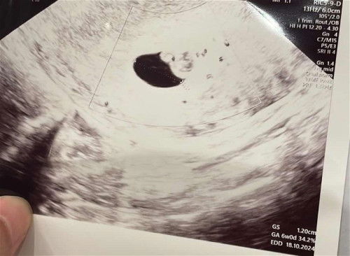 Hematoma subchrionic? USG 6Week