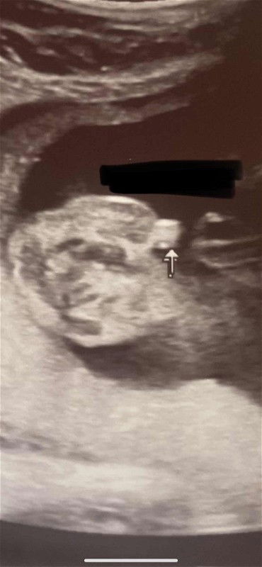 Gender check ultrasound