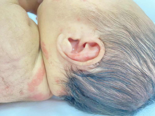 ลูก 1 เดือน มีผื่นที่หน้าและหลัง มีวิธีรักษาอย่างไรบ้างคพ อาบขมิ้น เลิกใช้สบู่ ทาเฟแอนเม ก็ยังไม่หายเลยค่ะ 2สัปดาห์แล้วยุบแล้วก็ขึ้น