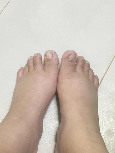บวมเเบบนี้ตอน 39 วีค ปกติมั้ยค่ะ
