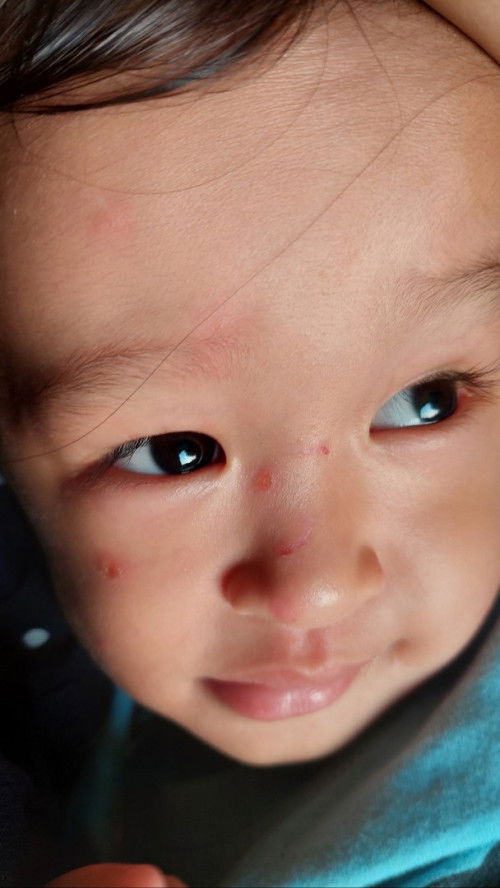 Kulit anak seperti tersundut rokok