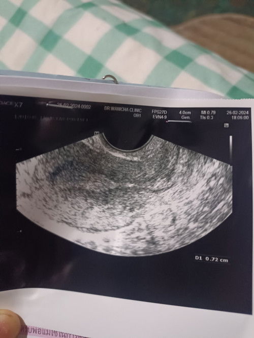 แม่ๆบ้านไหนเป็นแบบนี้บ้างคะ
ท้องแรกหลุด ท้องนี้ท้อง 2 คะ