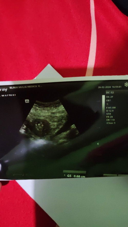 Di USG penebalan dinding rahim tapi tespeck positif