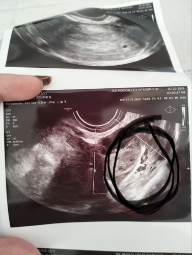 Bakit may dugo sa matres ko?