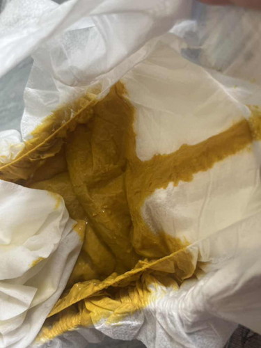 Salam hii momy nk tnya .. Najis baby normal ke cair mcm ni ?? Atau bby tk sesuai ssu formula ?