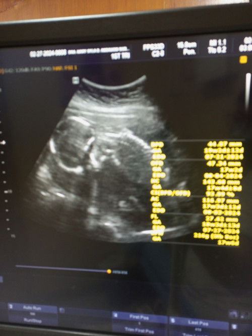 May cases po ba dito na nakadapa si baby sa loob ng tiyan? Bakit kaya nakadapa si baby?