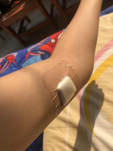 ฝังยาคุมกำเนิด