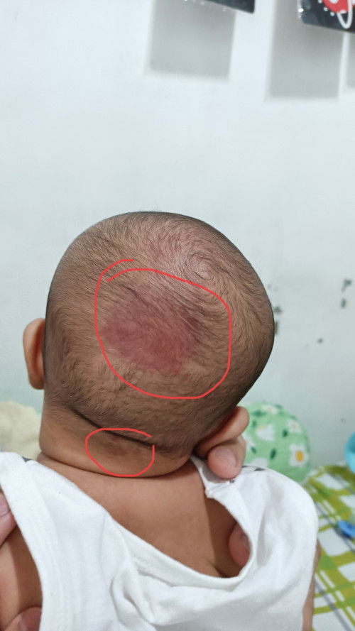 Ano po kaya tong namuong dugo sa ulo ni baby?