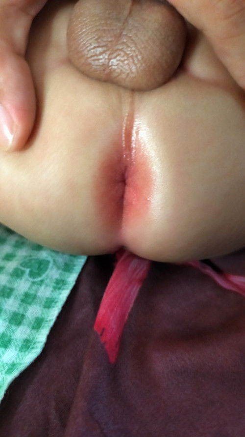 Mereh merah sekita anus bayi