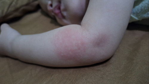 Gatal-Gatal ini apa ya??