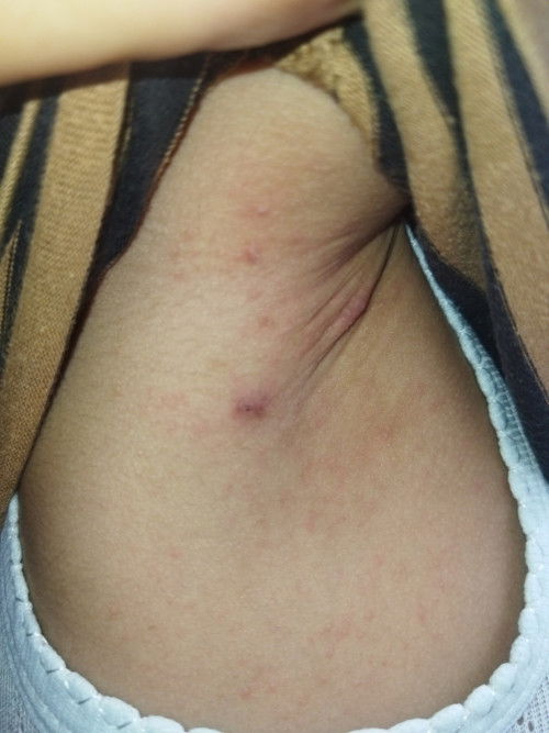 BINTIK MERAH DAN GATAL