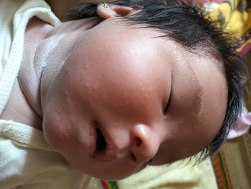 Mẹ nào biết cho m hỏi vs.be 24 ngay bị vài mục tren mặc la bị gi .lam sao het z mn oi.