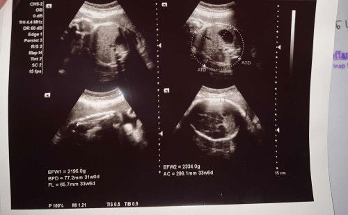 BPD selisih 4minggu sama Umur HPHT