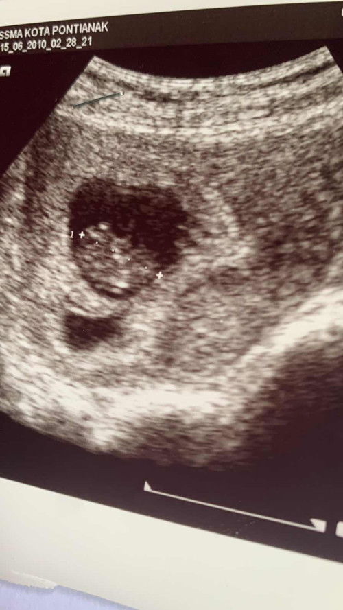 mau nnya usg 9 week ada 2 kantong yg satu terisi yg satu blom