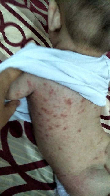 Scabies baby 6 bulan