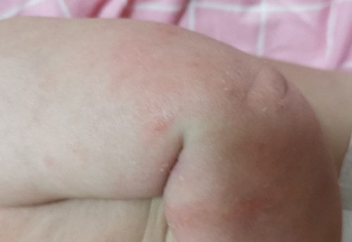 Eczema makin teruk lepas cucuk 4 bulan