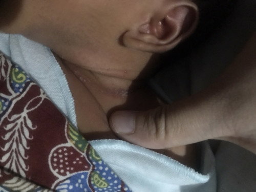 Muncul bintik2 kecil pada lipatan leher bayi