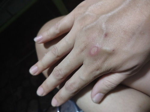 มีบาดแผลปวด