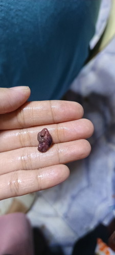 nakunan po ba ako? positive po ako sa pt, pero medyo dinugo ako, nakuha ko po ito nung umihi ako