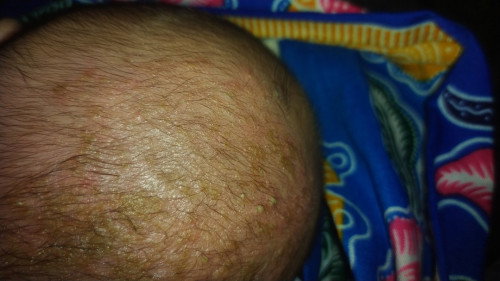 Kerak pada kepala bayi