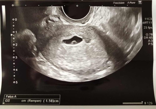 อายุครรภ์ 7 สัปดาห์